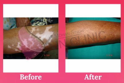 Vitiligo Treatment in hand Results