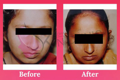 Vitiligo Treatment India Results
