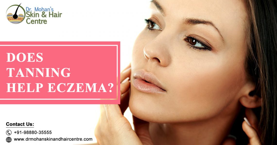 Can my Eczema disappear with Tanning and Controlled UV rays?