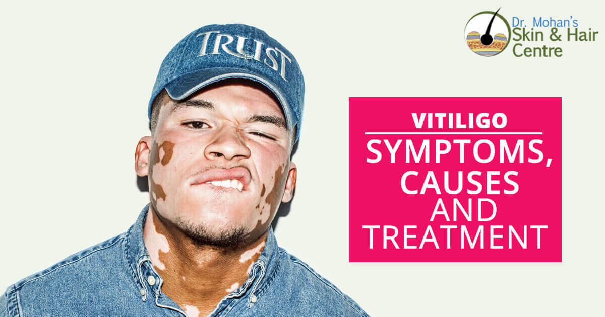 Vitiligo – Symptoms, Causes, And Treatment