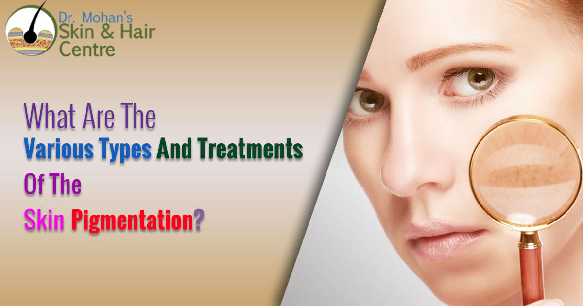 What Are The Various Types And Treatments Of The Skin Pigmentation?