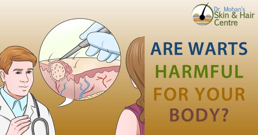 Are Warts Harmful For Your Body?