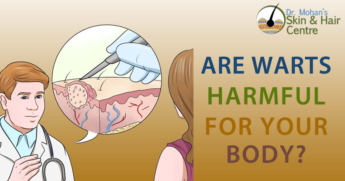Are Warts Harmful For Your Body?