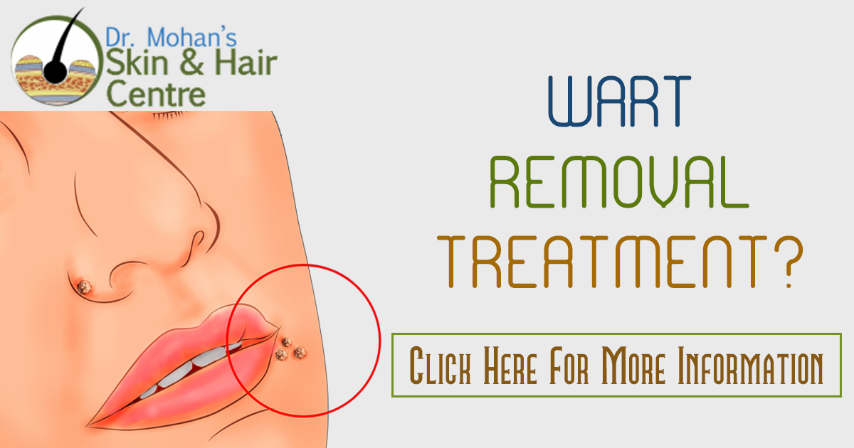 Warts and Its best treatment in India