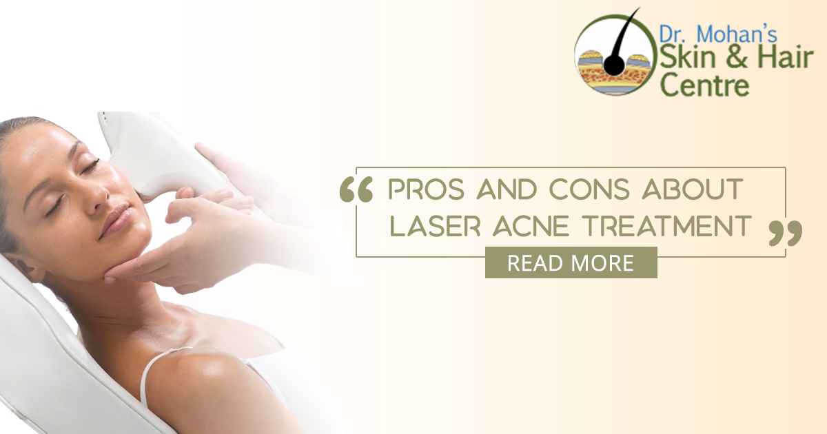 Laser Acne Treatment - Its Pros and Cons