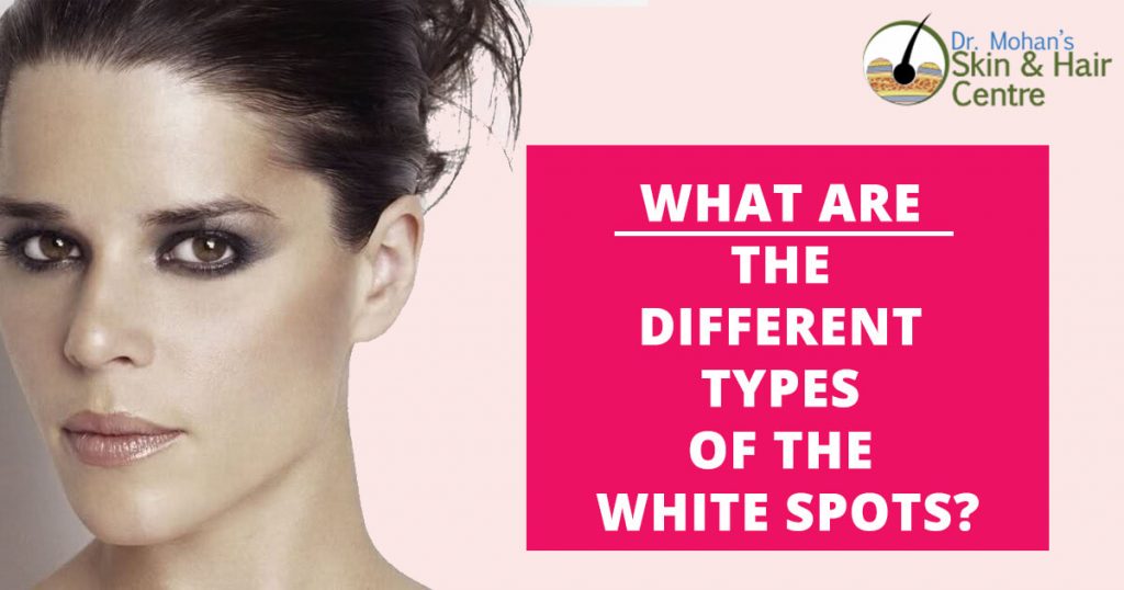 What Are The Different Types Of The White Spots?