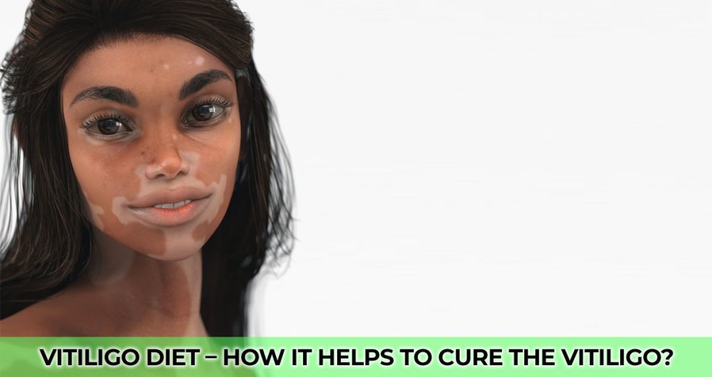 Vitiligo Diet – How it helps to cure the Vitiligo?