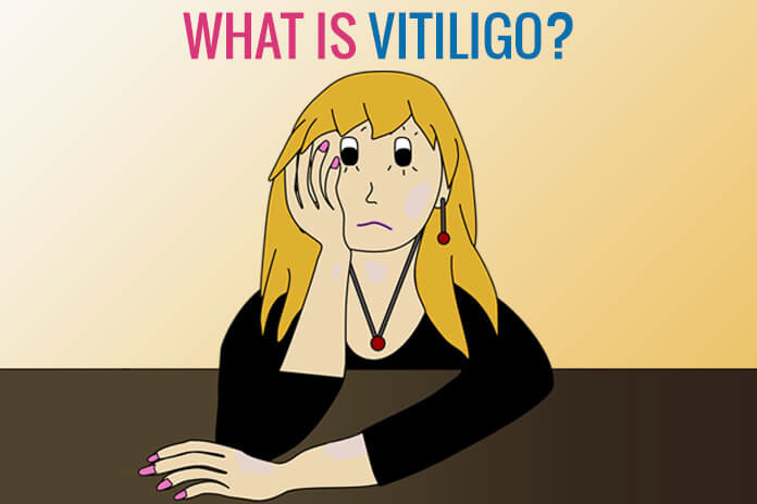 What are the Various Treatments for the Vitiligo?