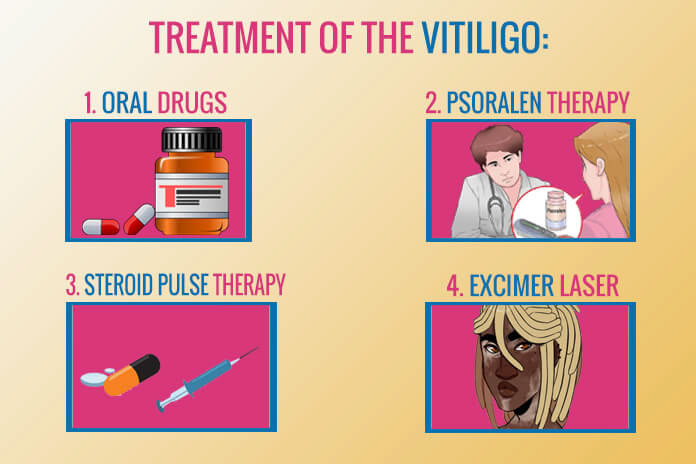 Treatment of the vitiligo:
