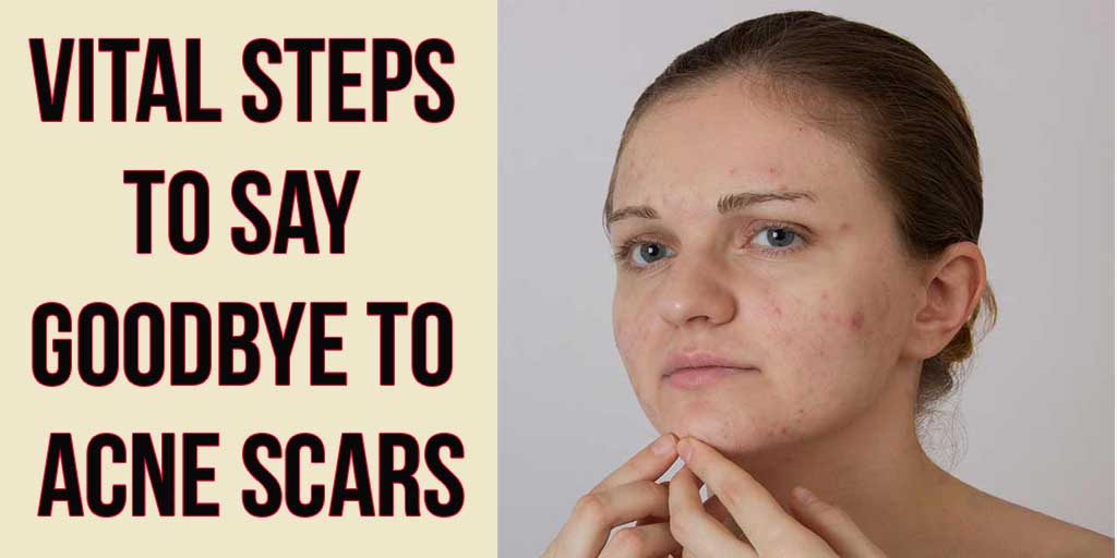 Vital Steps to Say Goodbye to Acne Scars