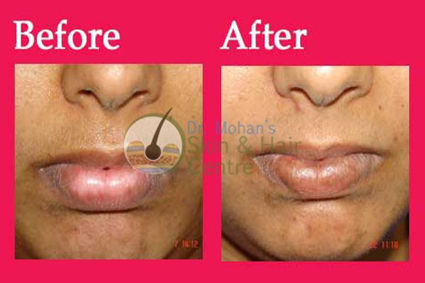 Vitiligo on Lips Treatment Results India