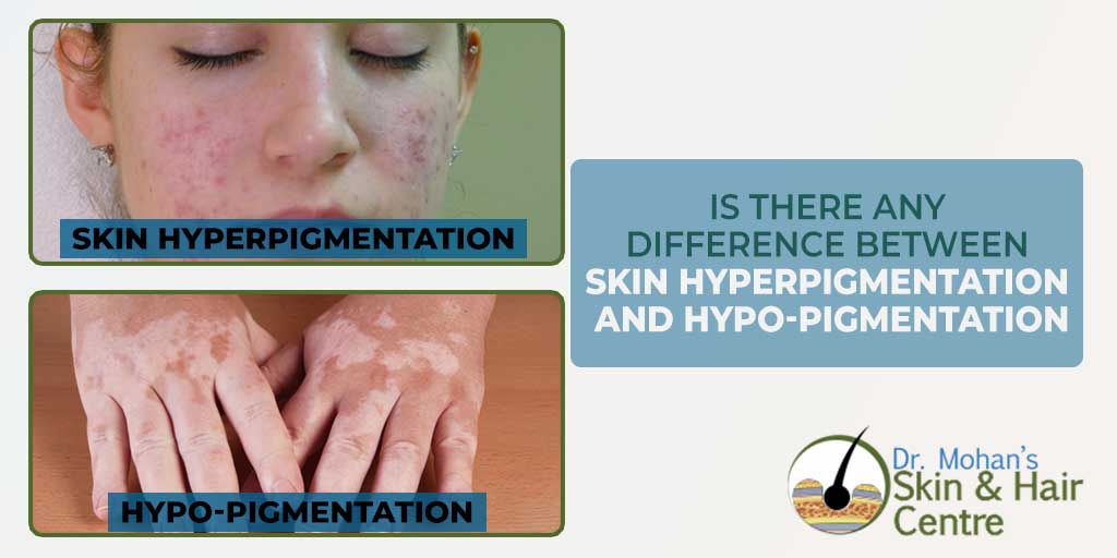 Is There any Difference Between Skin Hyperpigmentation and Hypo-Pigmentation