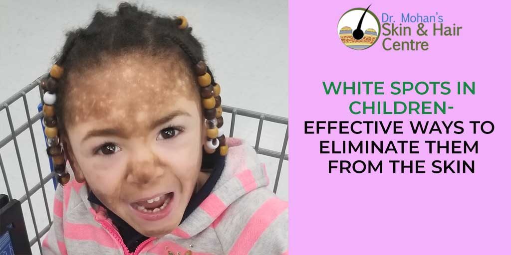 White Spots in Children- Effective Ways to Eliminate them from the Skin