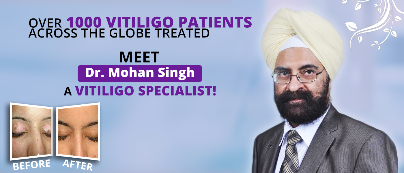 Vitiligo specialist Dr. Mohan Singh