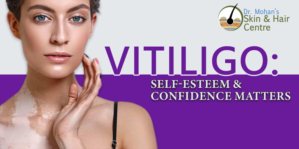 Vitiligo: Self-Esteem & Confidence Matters