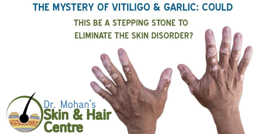The Mystery of Vitiligo & Garlic: Could This Be A Stepping Stone To Eliminate the Skin Disorder?