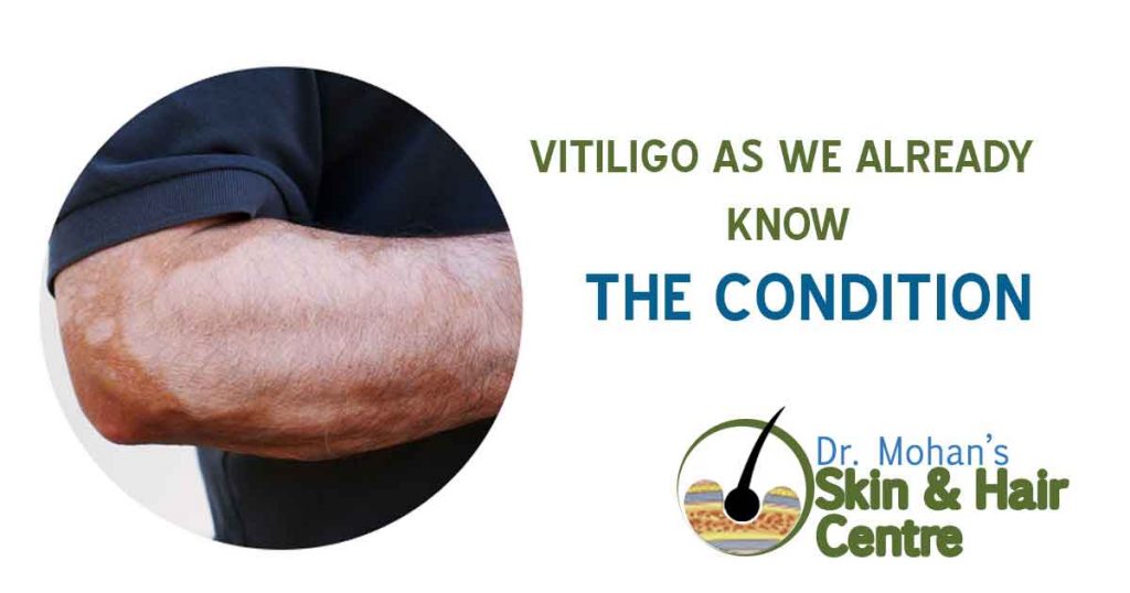 Vitiligo as We Already Know the Condition