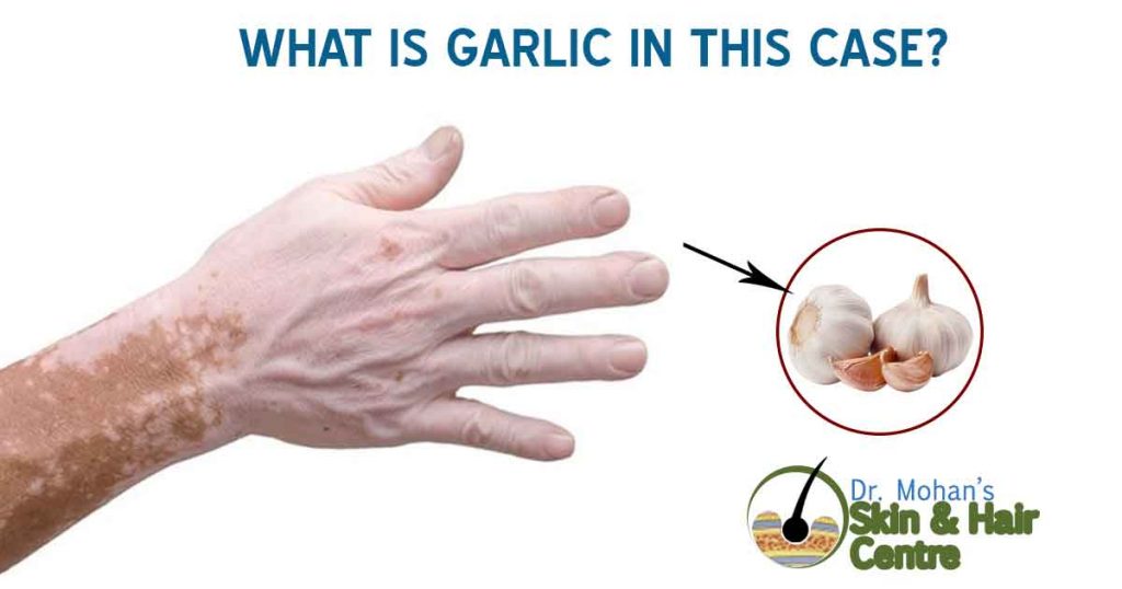 What is Garlic in This Case?