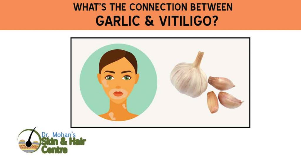 What’s the Connection Between Garlic & Vitiligo?