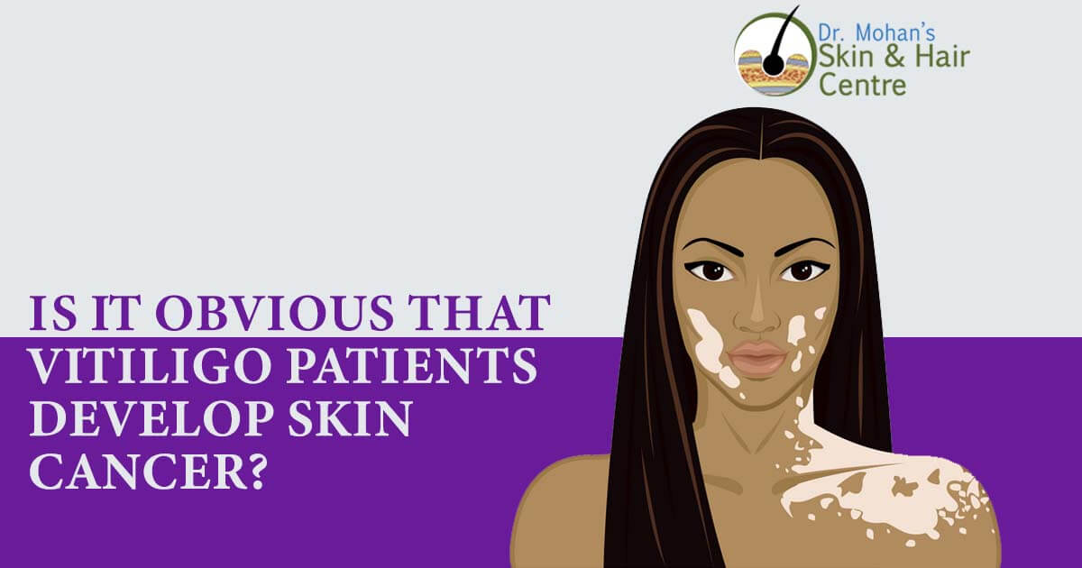 Is It Obvious That Vitiligo Patients Develop Skin Cancer?