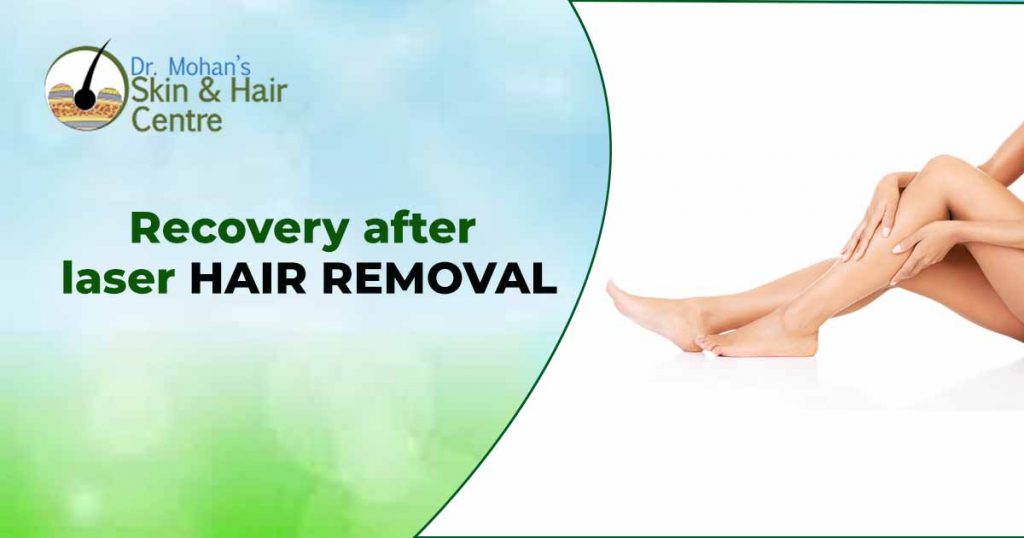 Recovery after laser hair removal