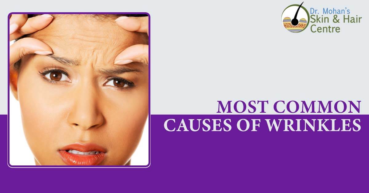 Most Common Causes Of Wrinkles