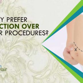 Why Prefer Liposuction Over The Other Procedures?