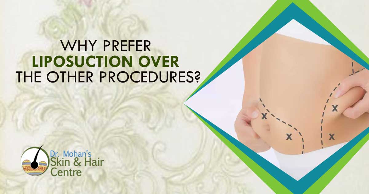 Why Prefer Liposuction Over The Other Procedures?