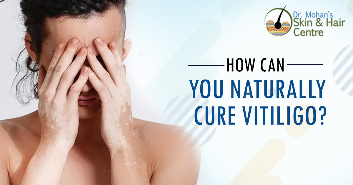 How Can You Naturally Cure Vitiligo