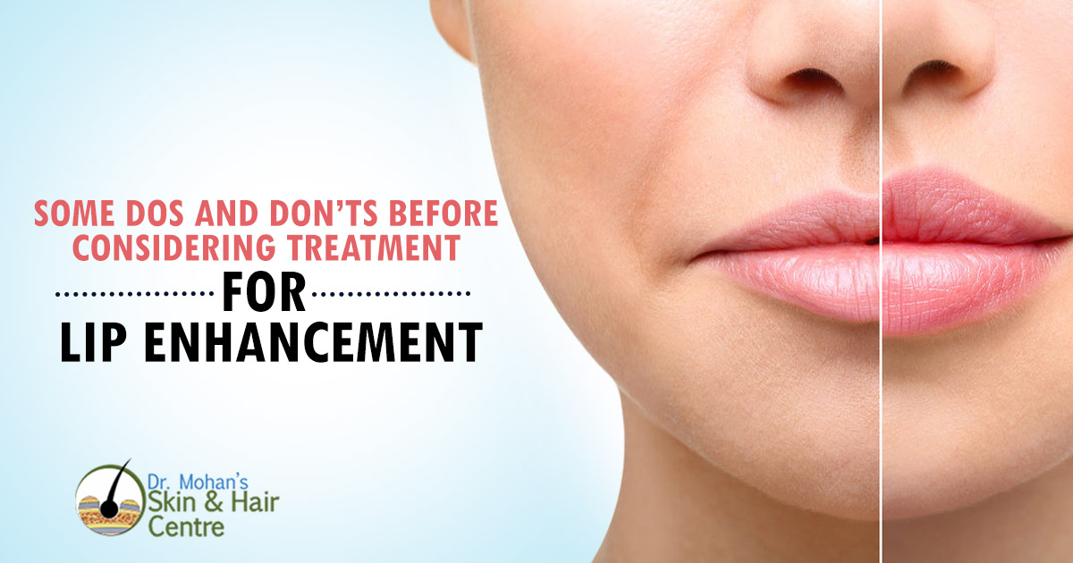 Pre lip Enhancement Surgery Tips