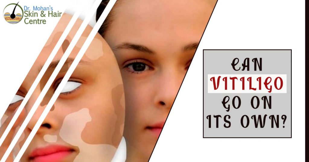 Can Vitiligo go on its own