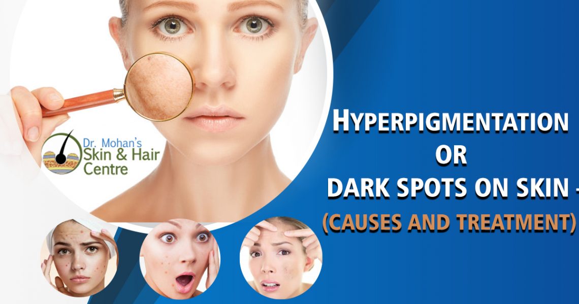 Hyperpigmentation or Dark Spots On Skin \u2013 Causes And Treatment