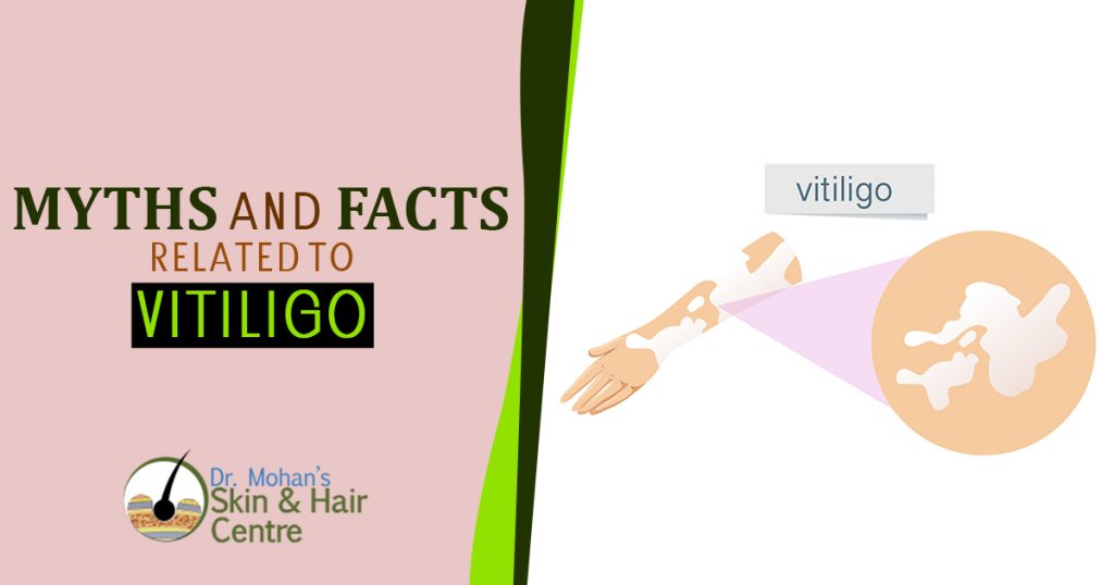 Myths And facts related To Vitiligo