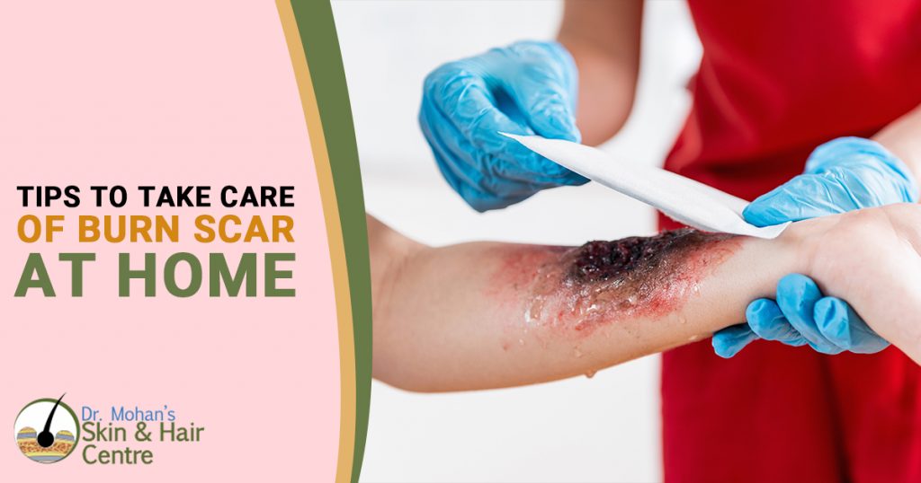 Tips to Take care of Burn scar at home