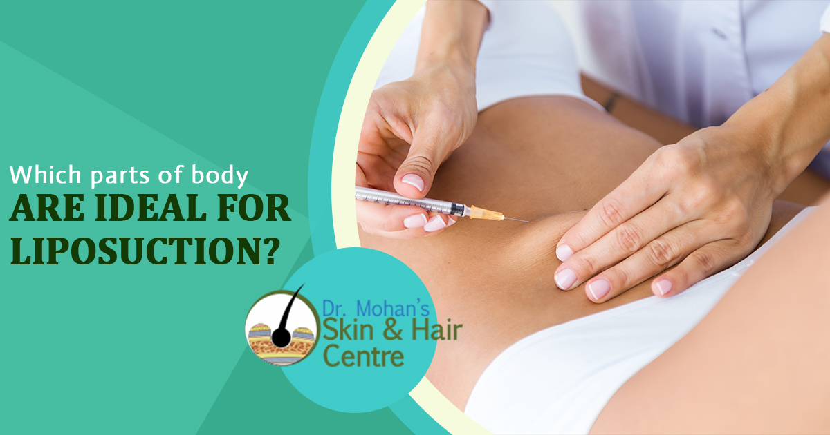 Which parts of body are ideal for liposuction