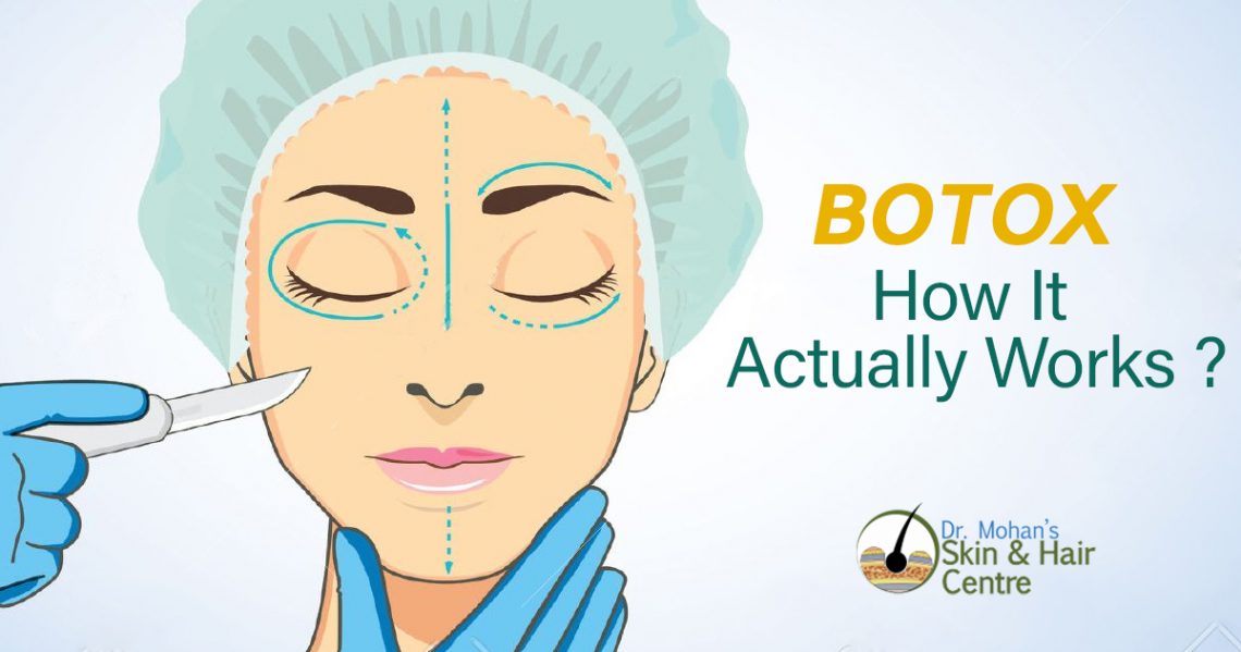 Botox: How It Actually Works?