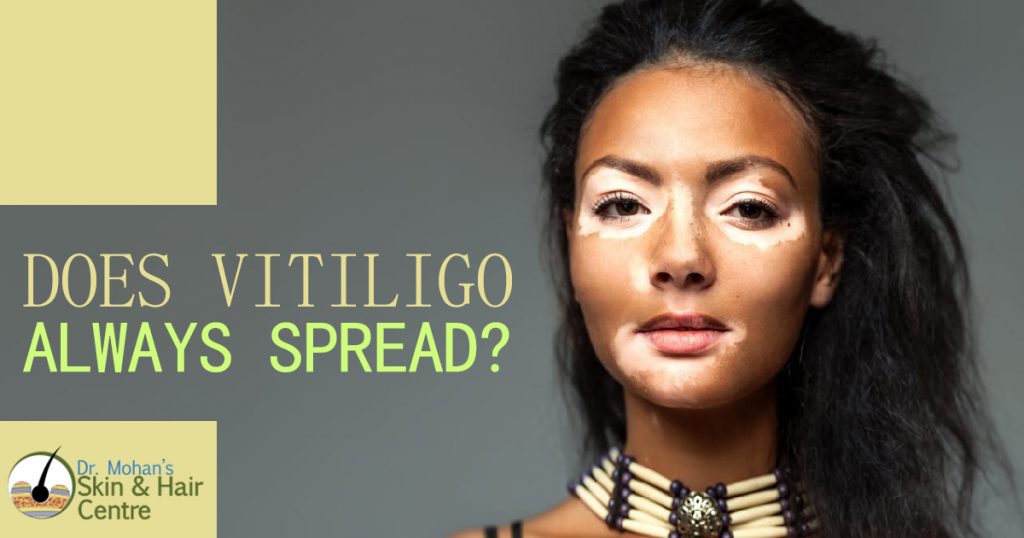 Does Vitiligo Always Spread