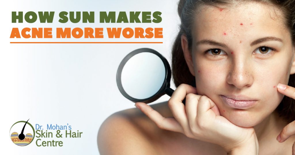 How Sun Makes Acne more Worse