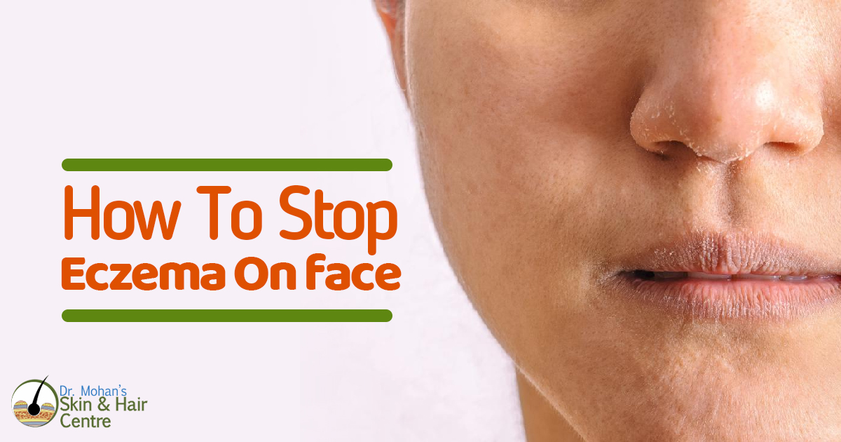 How to stop eczema on face