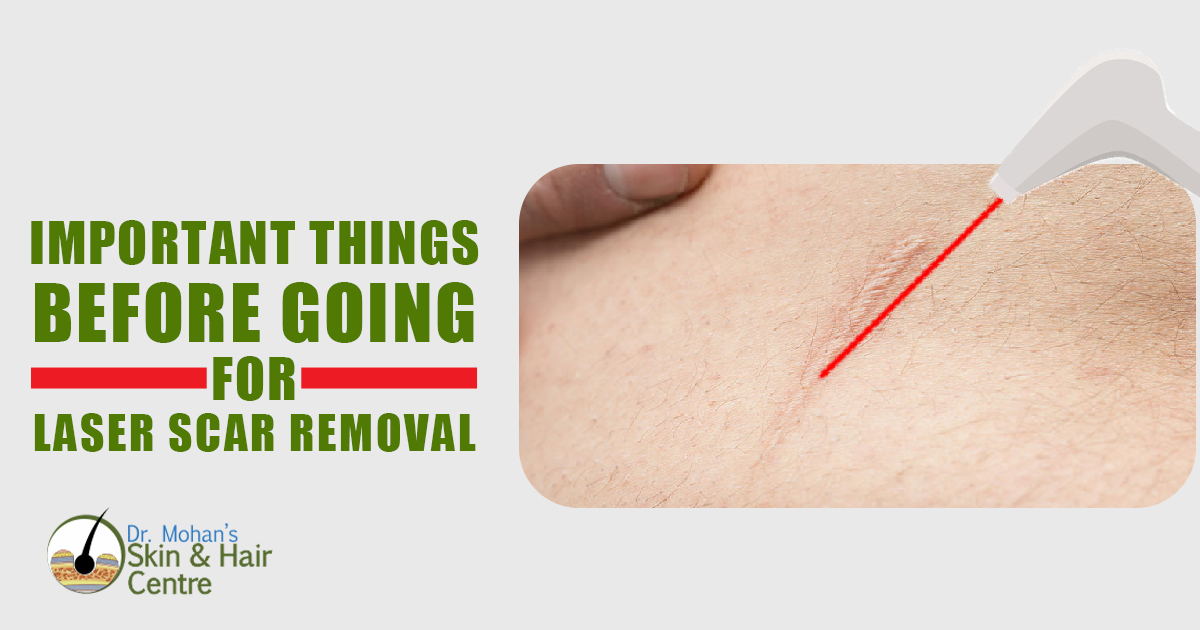 Important Things Before Going for Laser Scar Removal