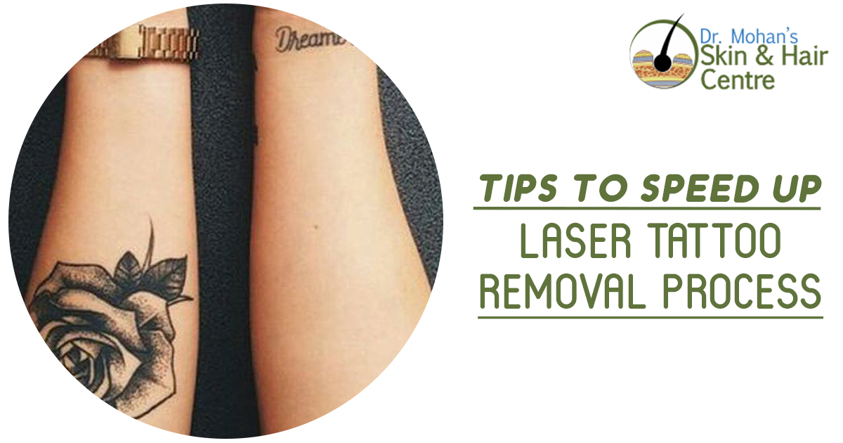 Tips to speed up laser tattoo removal process