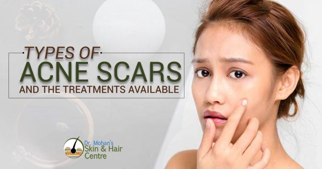 Types of Acne Scars and The treatments available