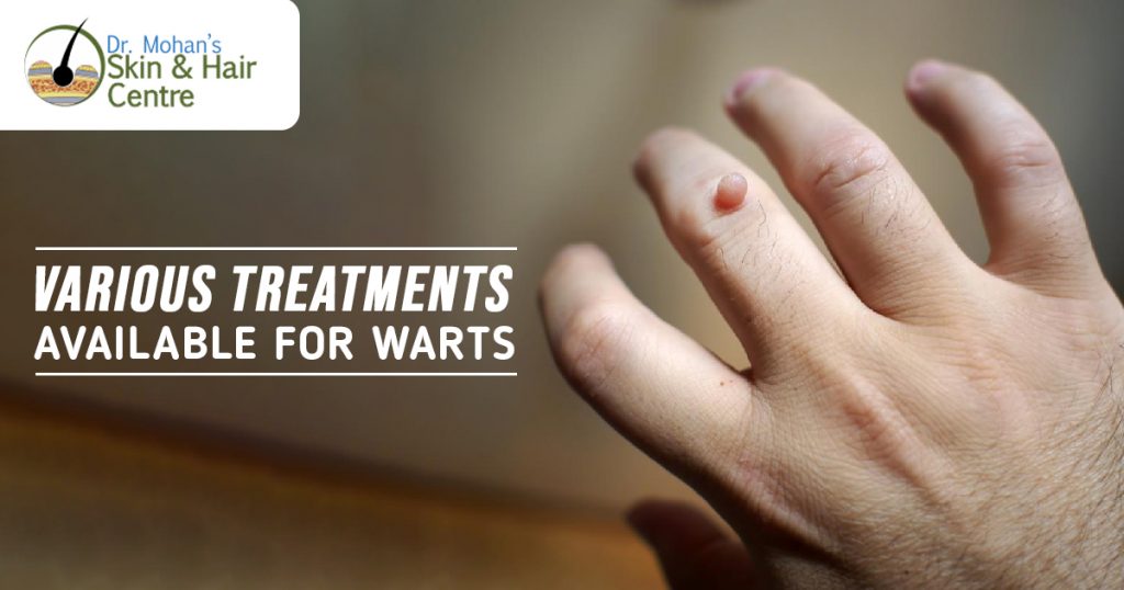 Various Treatments Available for Warts