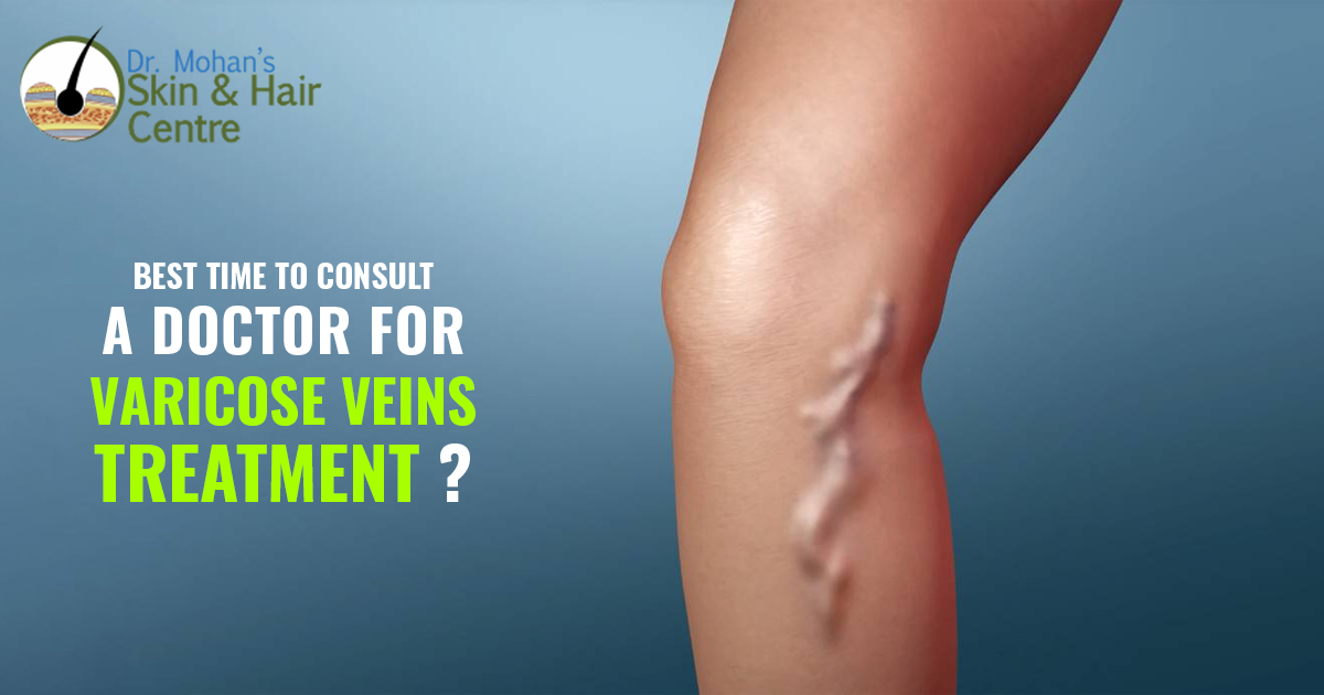 Best time to consult a doctor for varicose veins treatment
