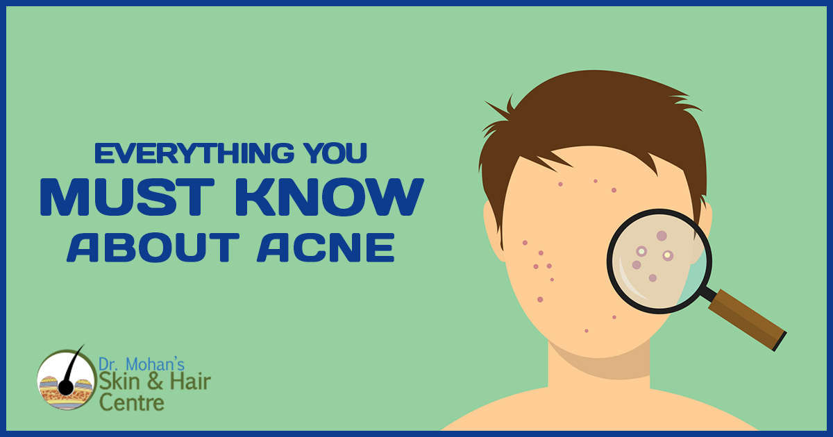 Everything you must know about Acne