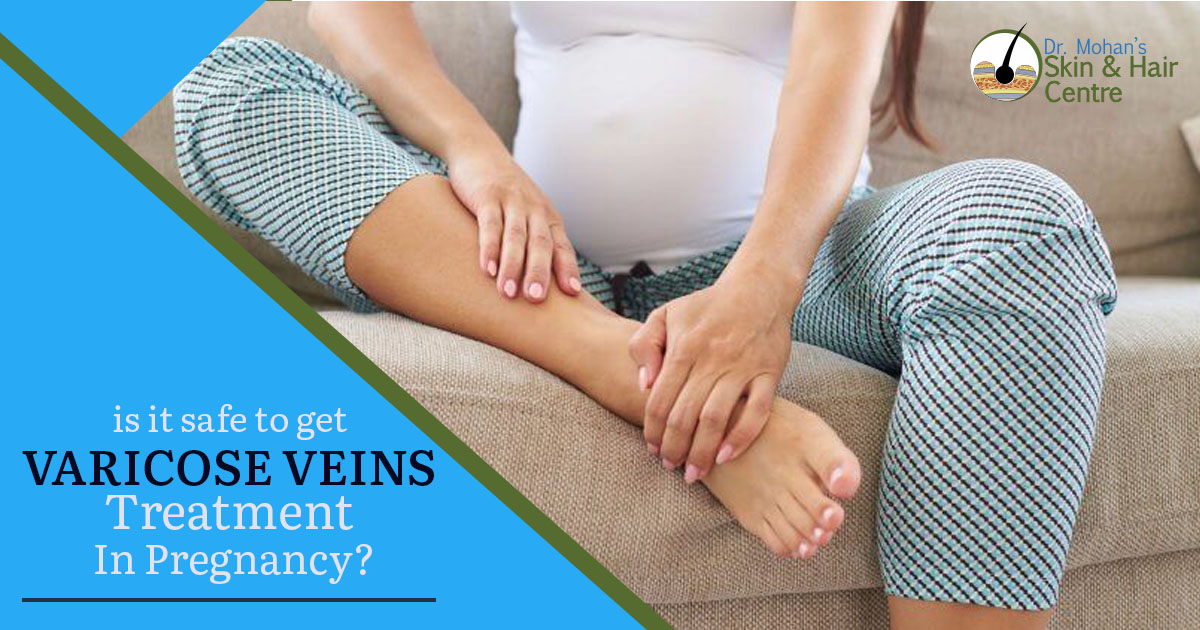 is it safe to get varicose veins treatment in pregnancy
