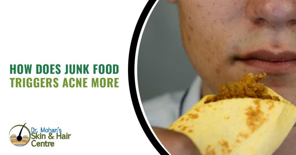 How does junk food triggers acne more copy