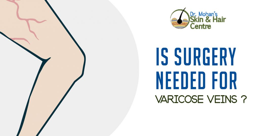 Is Surgery needed For Varicose Veins copy