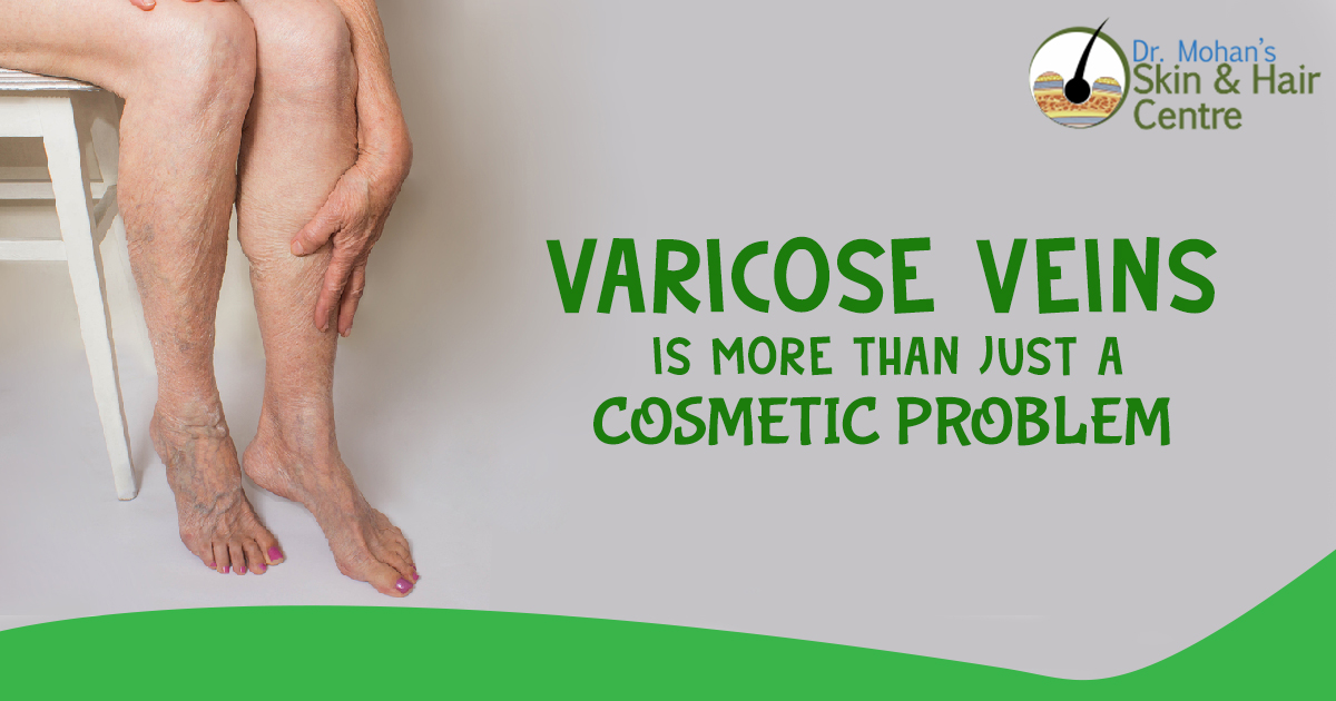 Varicose Veins is more than just a cosmetic problem