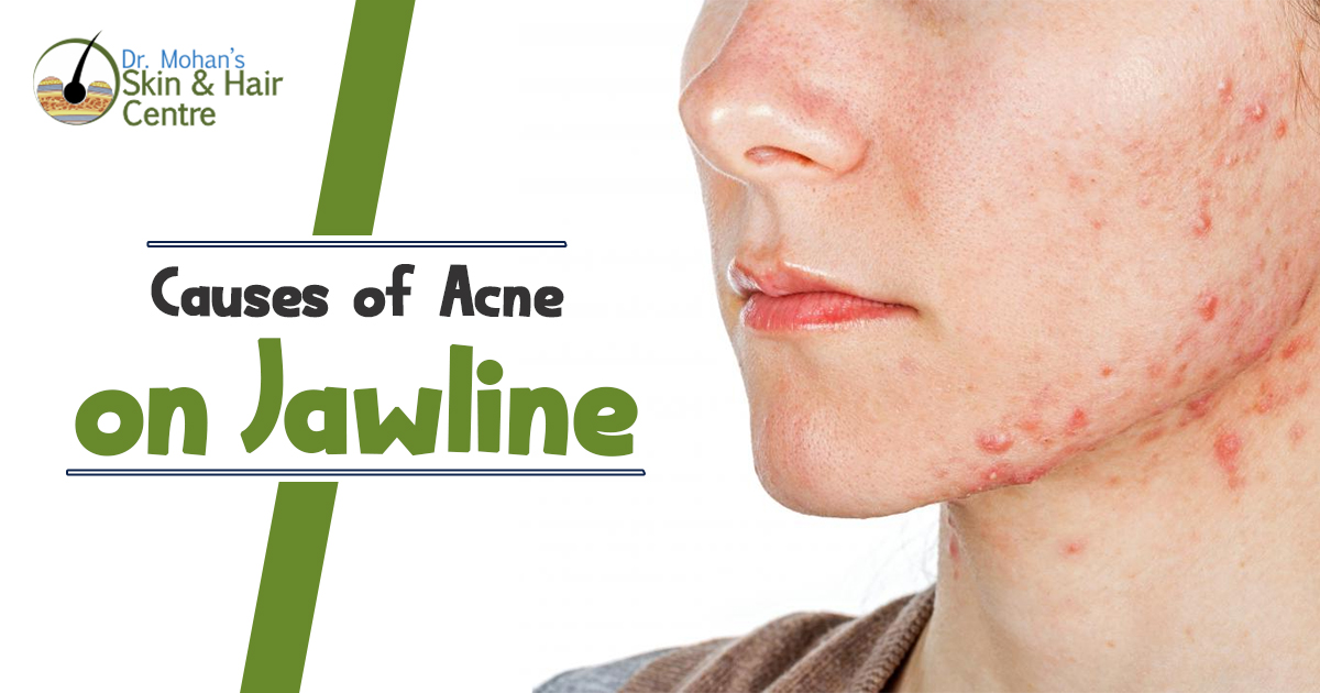 What are Causes of Acne on Jawline